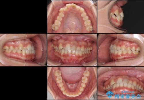 前歯の反対咬合　非抜歯のワイヤー矯正の治療前