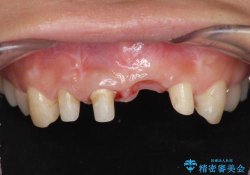 不良インプラントの除去・骨造成・歯肉移植・前歯審美セラミックブリッジ製作の治療中