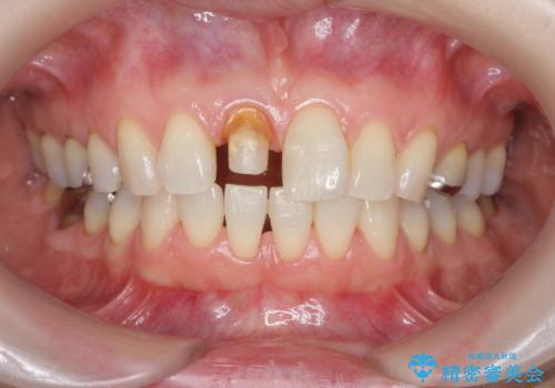 前歯の変色 セラミック審美補綴の治療中