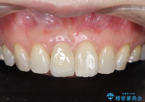 前歯の変色 セラミック審美補綴の症例 治療後