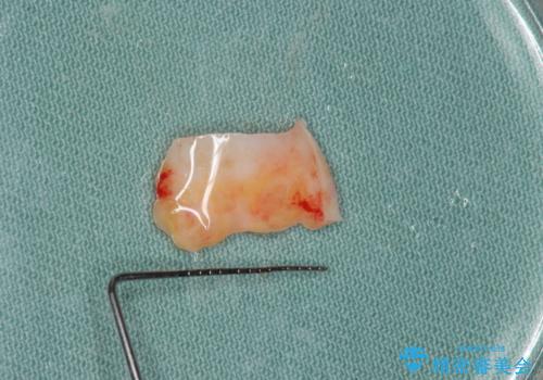 不良インプラントの除去・骨造成・歯肉移植・前歯審美セラミックブリッジ製作の治療中