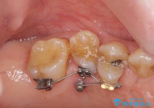 部分矯正を含む 歯周病治療 (再生治療・歯周ポケット除去・MTM・連結補綴)の治療前