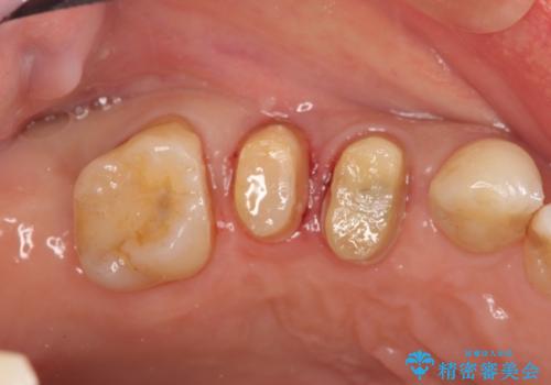 部分矯正を含む　歯周病治療 (再生治療・歯周ポケット除去・MTM・連結補綴)の治療中