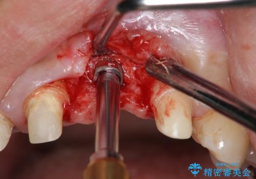 不良インプラントの除去・骨造成・歯肉移植・前歯審美セラミックブリッジ製作の治療中