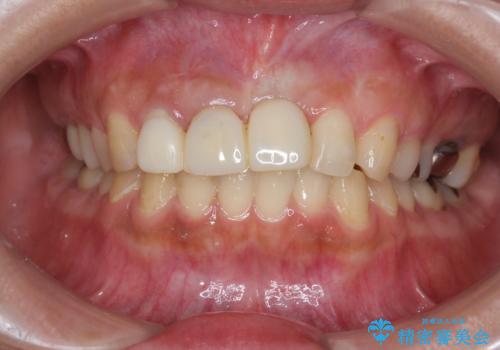 不良インプラントの除去・骨造成・歯肉移植・前歯審美セラミックブリッジ製作の治療前