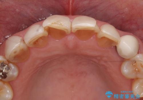 オールセラミッククラウン 前歯部の見た目の改善の治療前