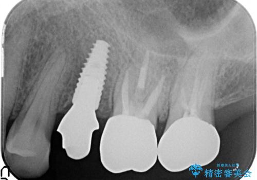 小臼歯部のインプラントの治療中