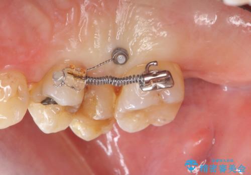 部分矯正を含む 歯周病治療 (再生治療・歯周ポケット除去・MTM・連結補綴)の治療中