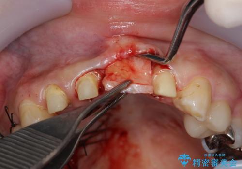 不良インプラントの除去・骨造成・歯肉移植・前歯審美セラミックブリッジ製作の治療中