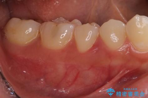 このままでは抜歯と言われた 失われた骨の再生治療 の治療前