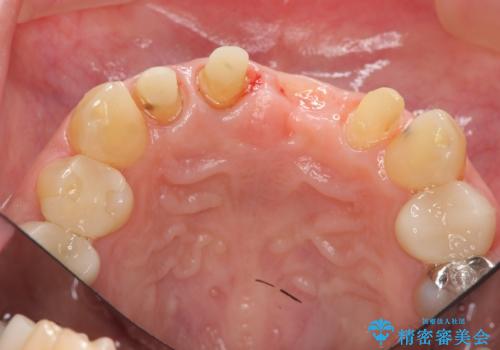 不良インプラントの除去・骨造成・歯肉移植・前歯審美セラミックブリッジ製作の治療中