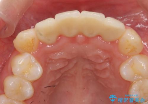 仮歯のまま放置してしまった　審美を改善したいの治療後