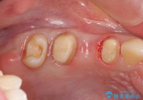 [深い虫歯] 根管治療・歯周外科治療を行い歯を保存するの治療中