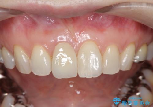 前歯の変色 セラミック審美補綴の治療後