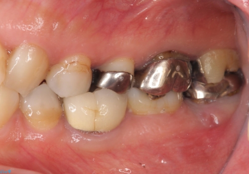 歯の破折による抜歯 インプラントによる咬合機能回復の治療前