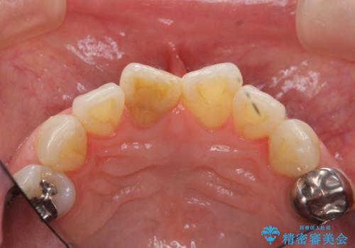 前歯の変色 セラミック審美補綴の治療前