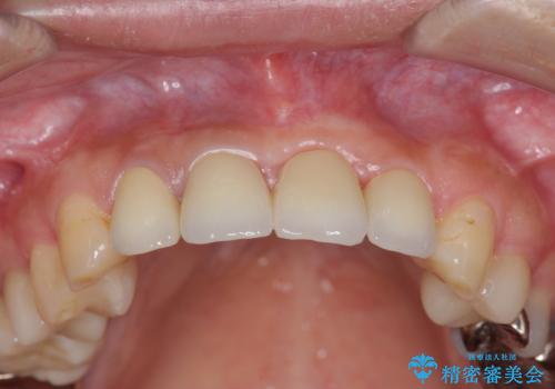不良インプラントの除去・骨造成・歯肉移植・前歯審美セラミックブリッジ製作の治療後