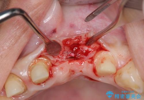 不良インプラントの除去・骨造成・歯肉移植・前歯審美セラミックブリッジ製作の治療前