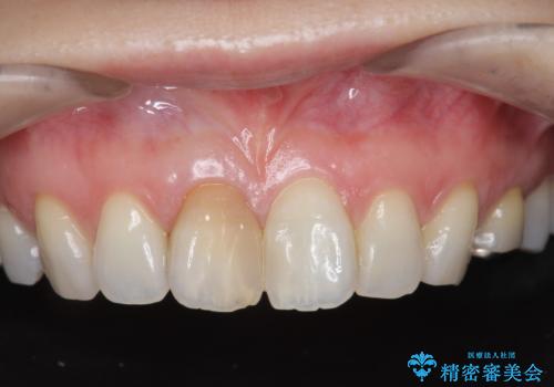 前歯の変色 セラミック審美補綴の症例 治療前