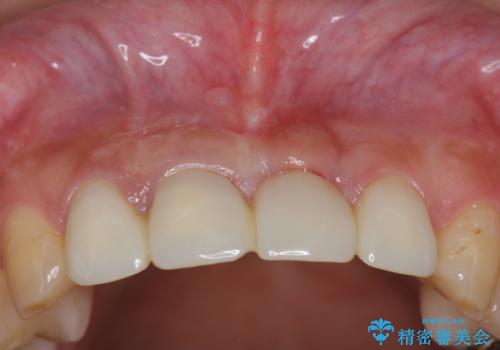 不良インプラントの除去・骨造成・歯肉移植・前歯審美セラミックブリッジ製作の治療前