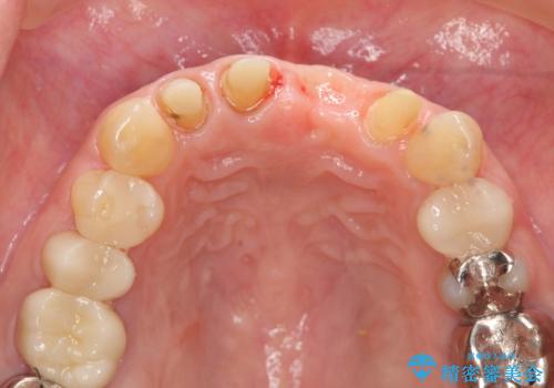 不良インプラントの除去・骨造成・歯肉移植・前歯審美セラミックブリッジ製作の治療中