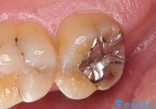 銀歯の劣化・セラミックインレー修復の症例 治療前