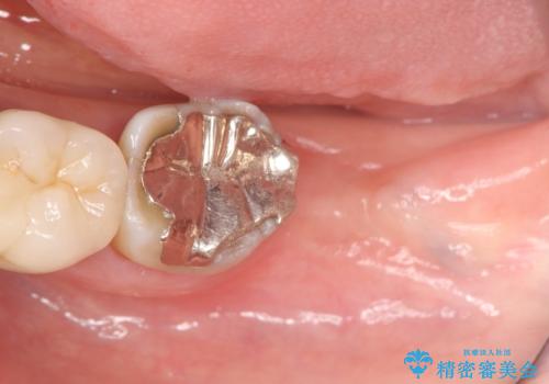 歯の破折による抜歯　インプラントによる咬合機能回復の治療中
