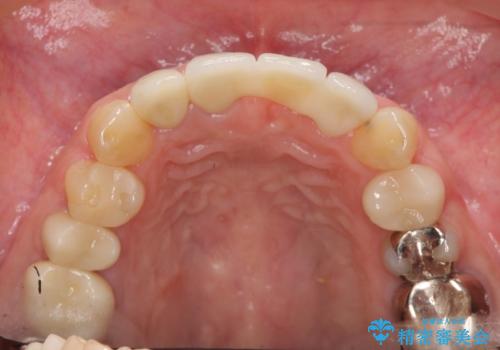 不良インプラントの除去・骨造成・歯肉移植・前歯審美セラミックブリッジ製作の治療後