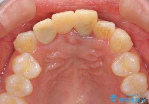 仮歯のまま放置してしまった　審美を改善したいの治療前