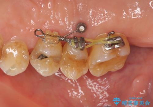 部分矯正を含む 歯周病治療 (再生治療・歯周ポケット除去・MTM・連結補綴)の治療中