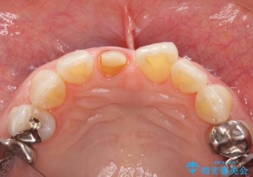 前歯の変色 セラミック審美補綴の治療中