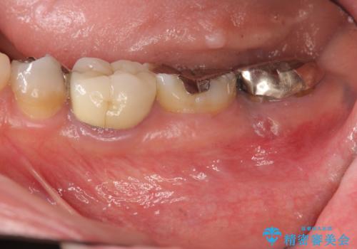 歯の破折による抜歯　インプラントによる咬合機能回復の症例 治療前