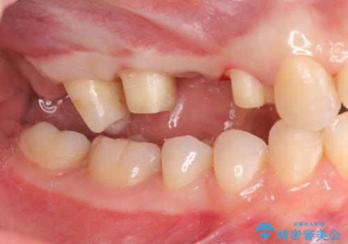 [深い虫歯] 根管治療・歯周外科治療を行い歯を保存するの治療中