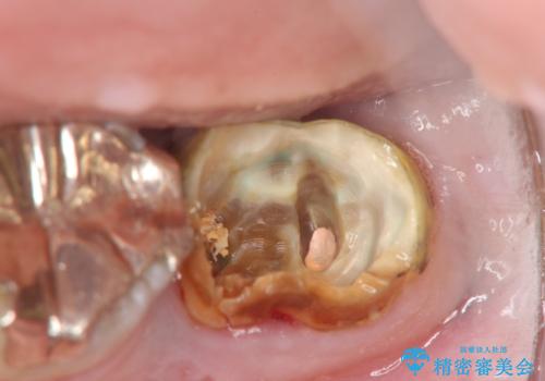 歯の破折による抜歯 インプラントによる咬合機能回復の治療前