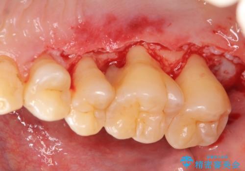 [歯周病治療]　再生療法　歯肉弁根尖側移動術の治療中