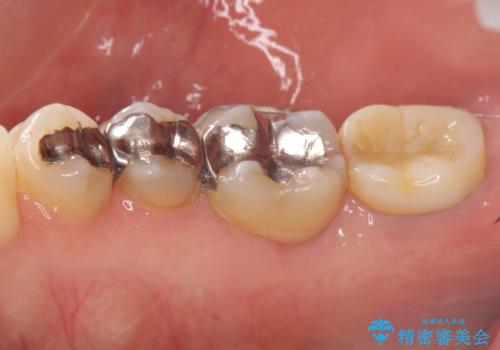 [大臼歯分岐部病変] ブリッジによる咬合機能回復の治療前