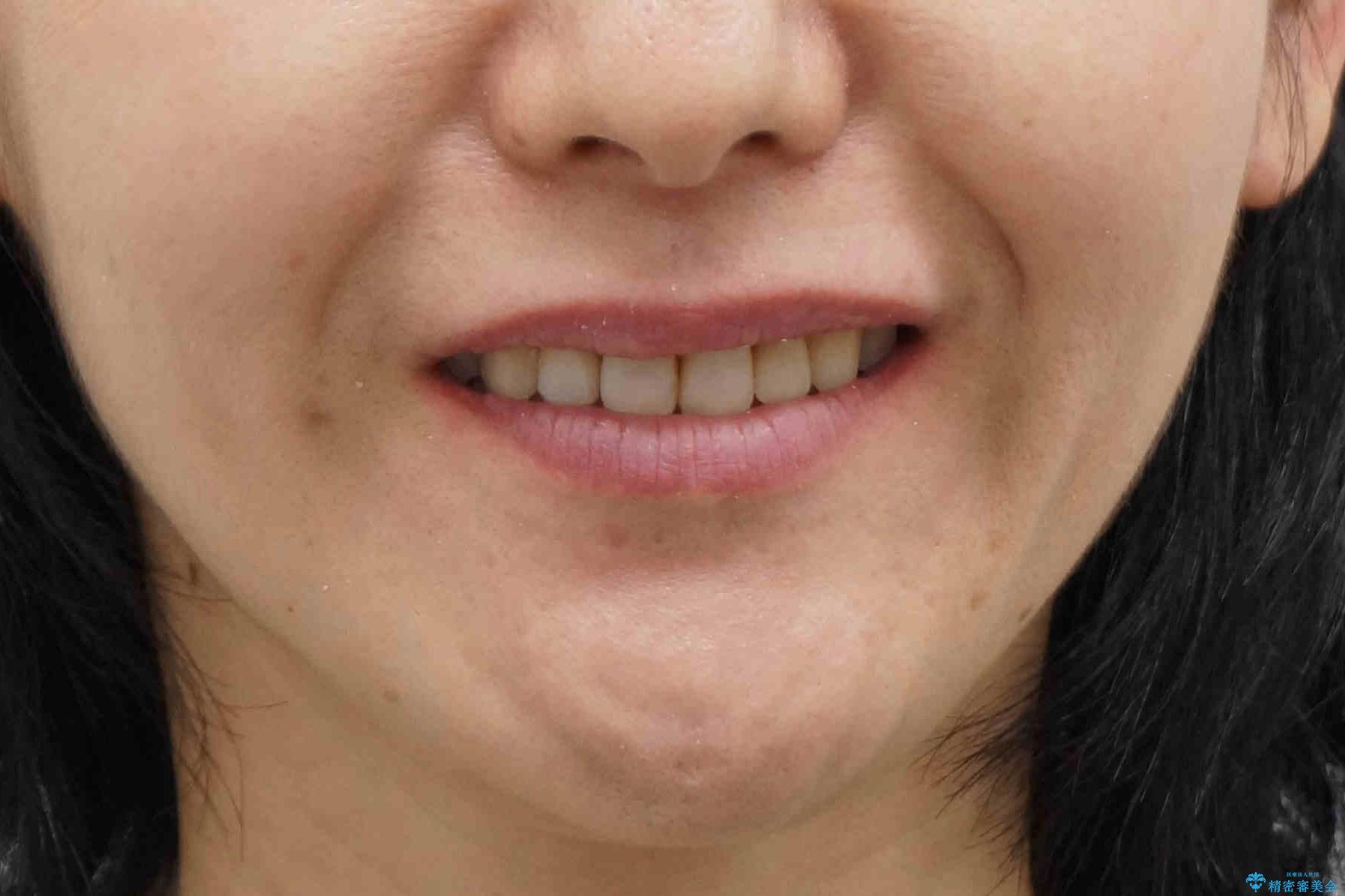 前歯で引っ込んでいる歯がある　他院で矯正200万と言われたの治療後（顔貌）