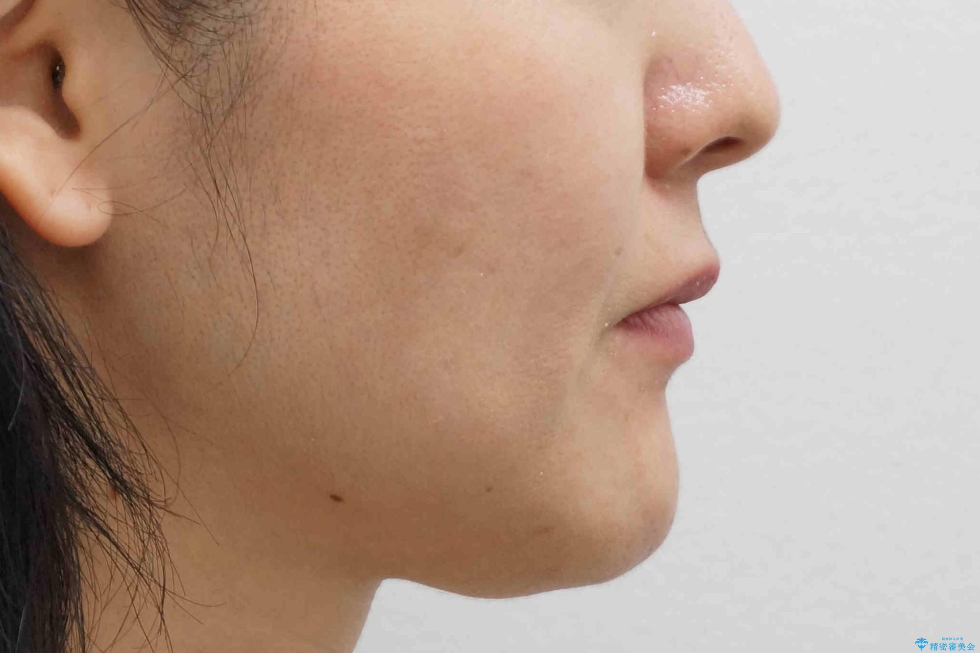 前歯で引っ込んでいる歯がある 他院で矯正200万と言われたの治療後(顔貌)