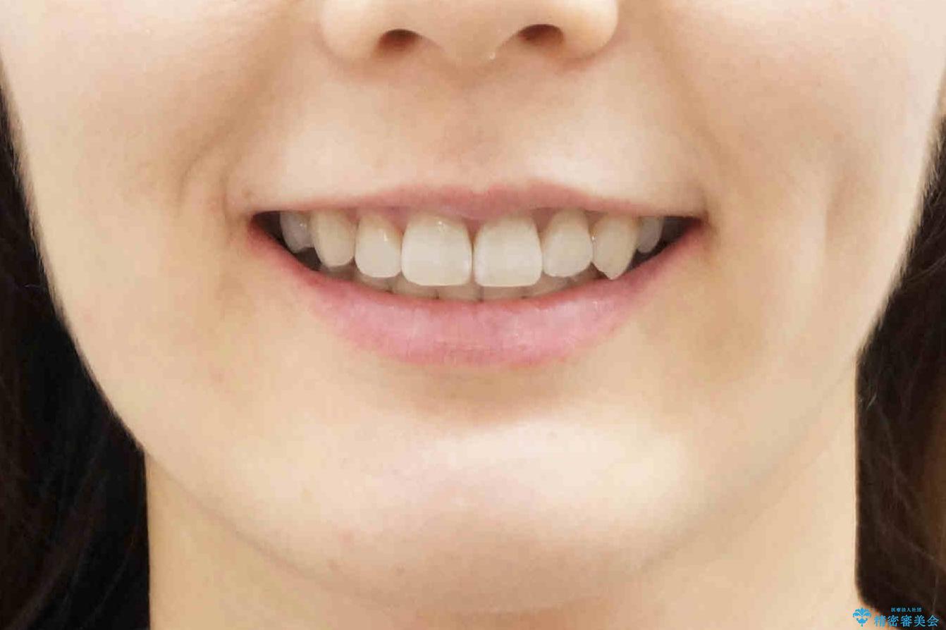 ハーフリンガル　犬歯のねじれ　歯根の外部吸収している歯を抜歯の治療後（顔貌）