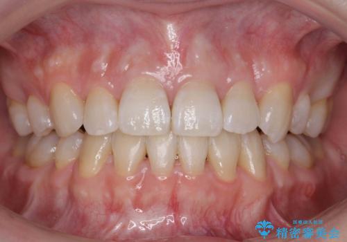 ハーフリンガル　犬歯のねじれ　歯根の外部吸収している歯を抜歯の症例 治療後