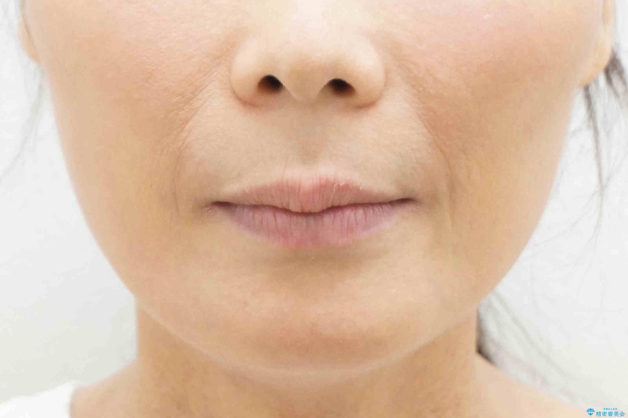 前歯のすきま 右上の小臼歯の垂直的骨吸収を抜歯で解決の治療後(顔貌)