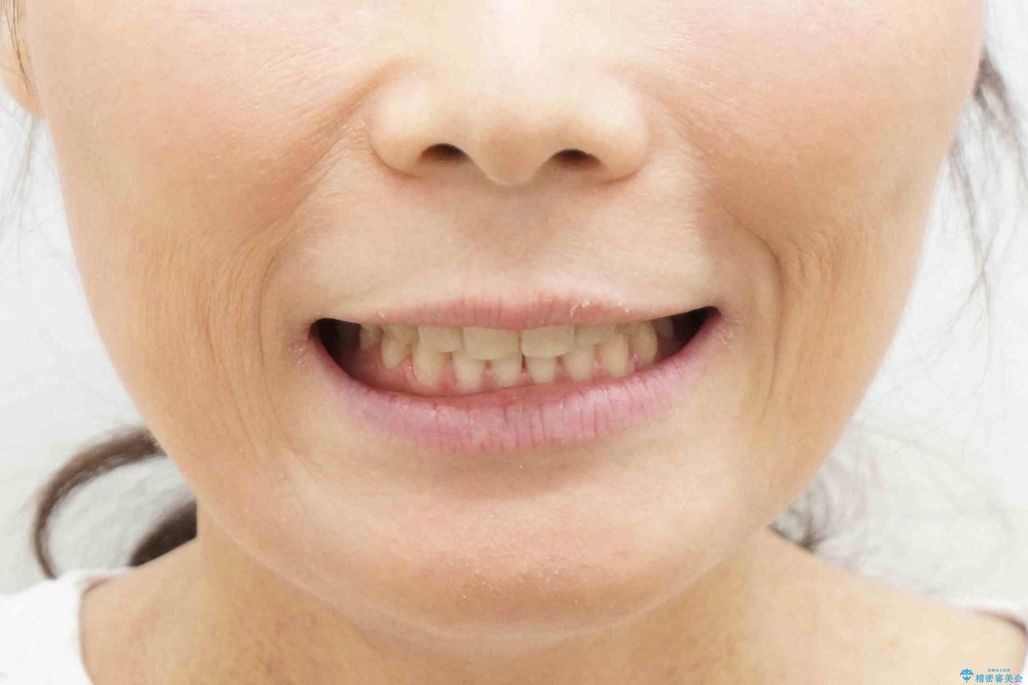 前歯のすきま　右上の小臼歯の垂直的骨吸収を抜歯で解決の治療後（顔貌）