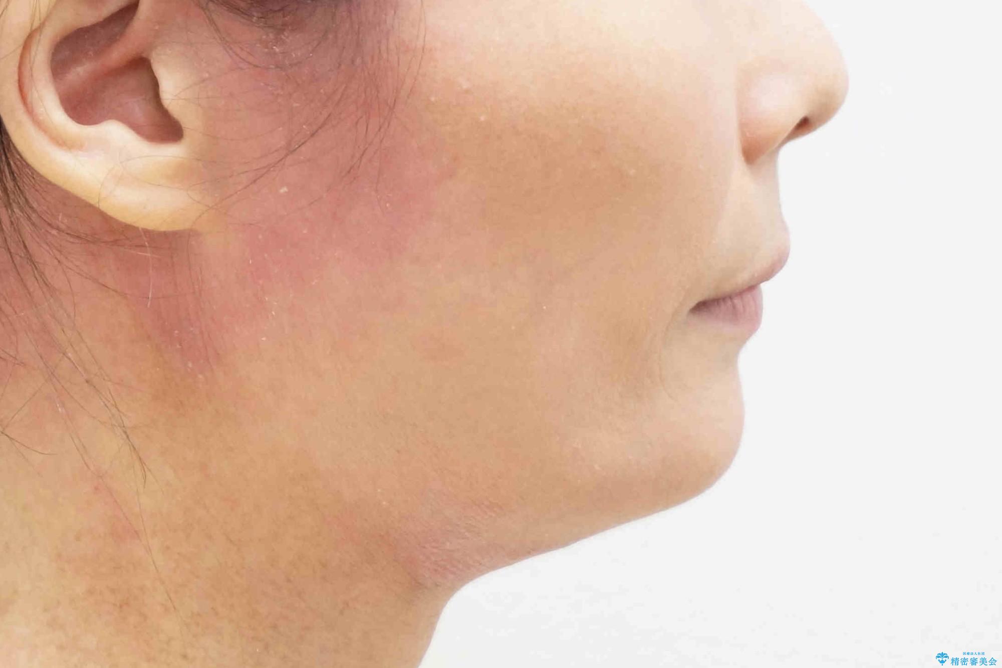 前歯のすきま 右上の小臼歯の垂直的骨吸収を抜歯で解決の治療後(顔貌)