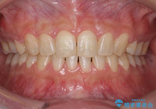 前歯のすきま　右上の小臼歯の垂直的骨吸収を抜歯で解決の治療後