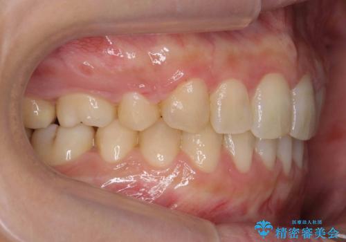 前歯のすきま 右上の小臼歯の垂直的骨吸収を抜歯で解決の治療後
