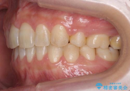 前歯のすきま 右上の小臼歯の垂直的骨吸収を抜歯で解決の治療前