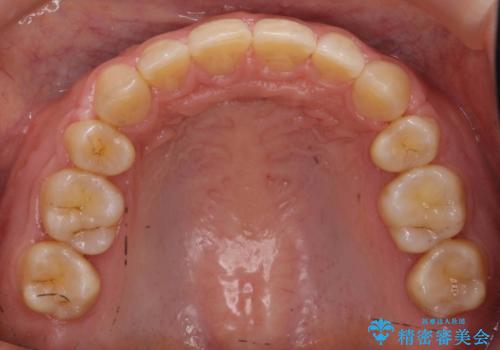 前歯のすきま 右上の小臼歯の垂直的骨吸収を抜歯で解決の治療後