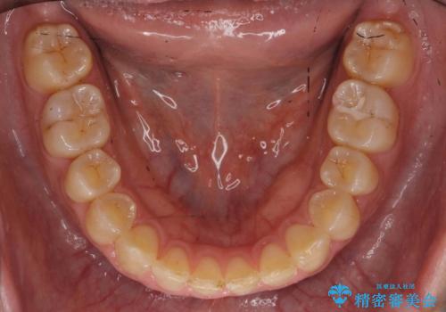前歯のすきま 右上の小臼歯の垂直的骨吸収を抜歯で解決の治療前