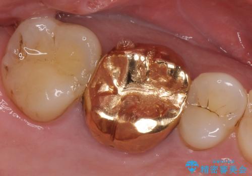 メタルボンドクラウン ゴールドから白い歯への治療前