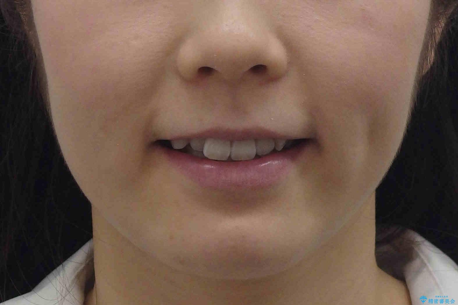 ハーフリンガル　犬歯のねじれ　歯根の外部吸収している歯を抜歯の治療前（顔貌）